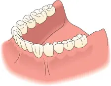 implant
